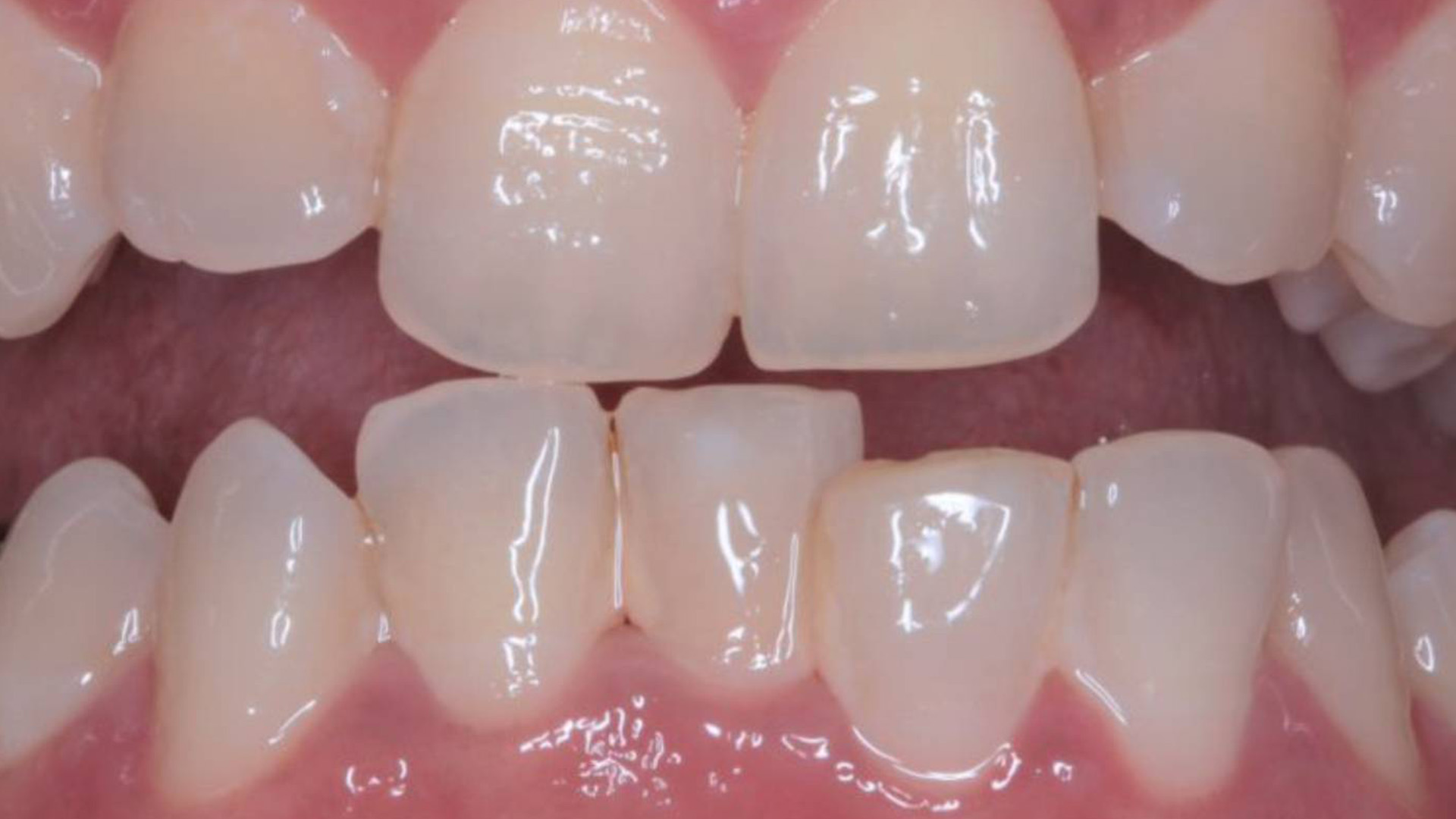 Inconistent Teeth Correction of Irregular Teeth in Gurgaon - Ministry of Smile