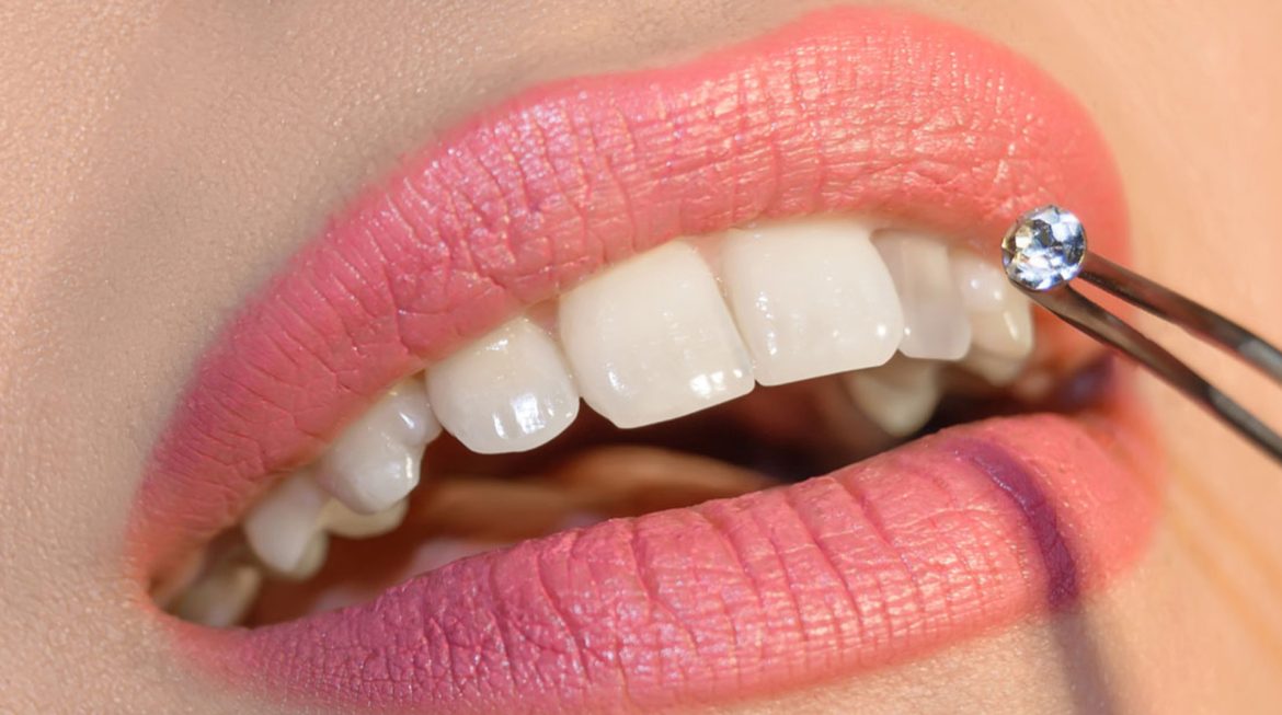 Tooth Jewellery Dentist in Gurgaon