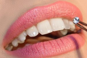 Tooth Jewellery Dentist in Gurgaon