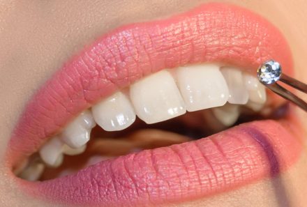 Tooth Jewellery Dentist in Gurgaon