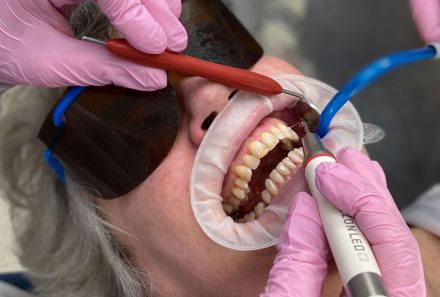 GBT (Guided Biofilm Therapy) and Its Benefits