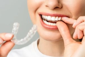 Invisalign in Gurgaon