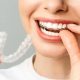 Invisalign in Gurgaon