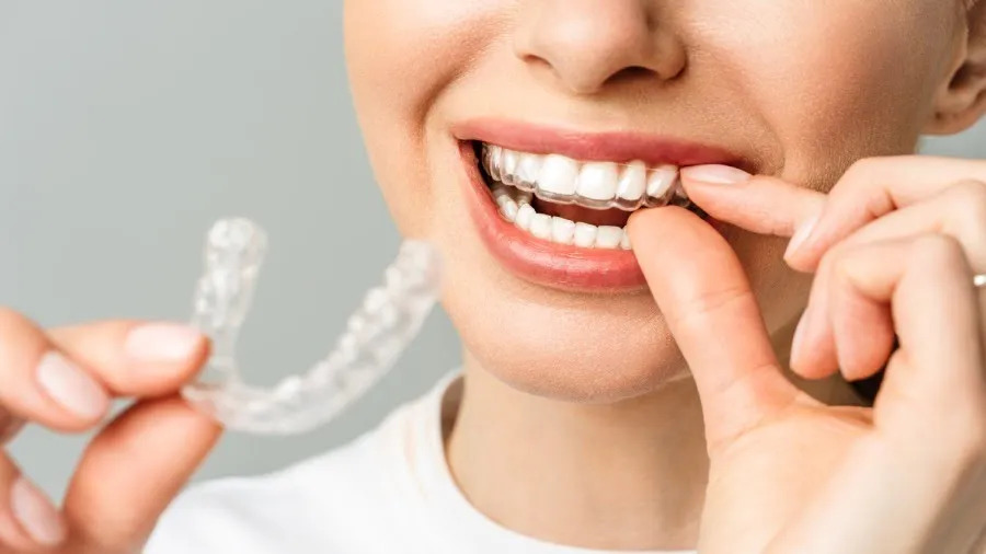 Invisalign in Gurgaon