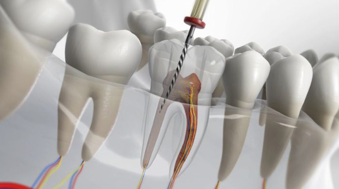 Painless RCT: Modern Root Canal Treatment for a Pain-Free Smile