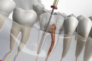 Painless RCT: Modern Root Canal Treatment for a Pain-Free Smile