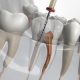 Painless RCT: Modern Root Canal Treatment for a Pain-Free Smile