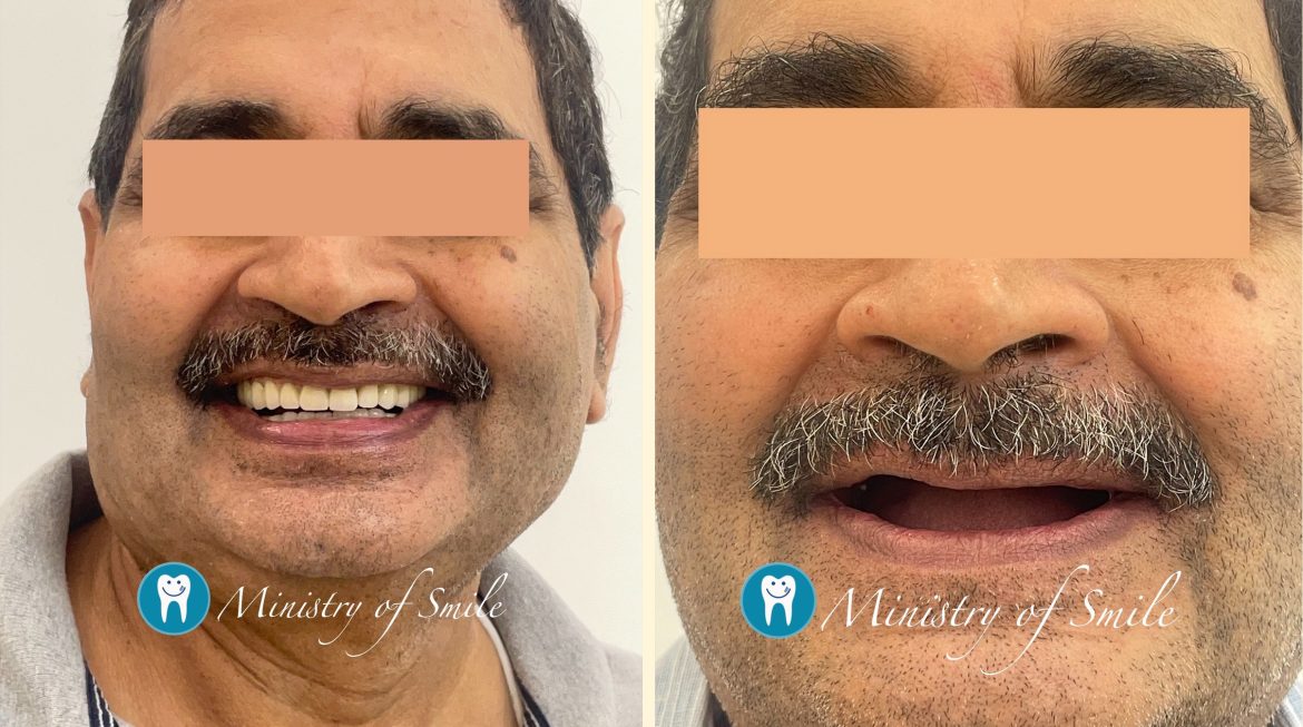 The Best Dental Implant Clinic Near Me in Gurgaon