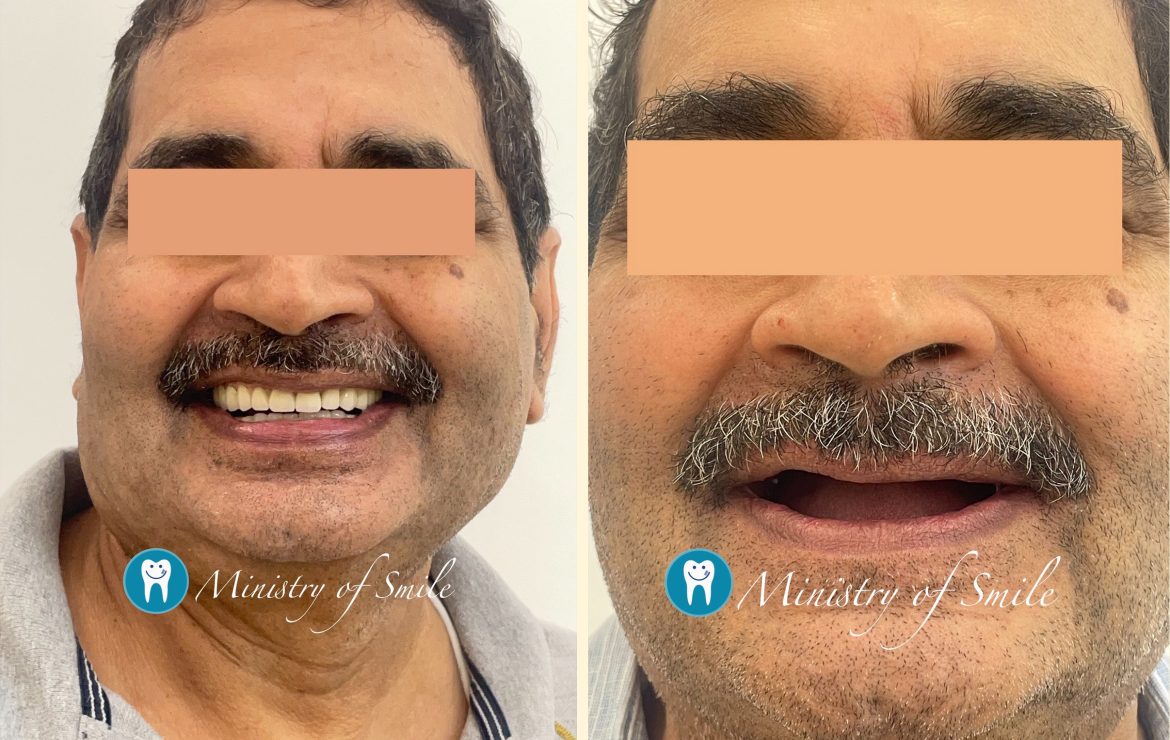The Best Dental Implant Clinic Near Me in Gurgaon