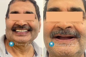 The Best Dental Implant Clinic Near Me in Gurgaon