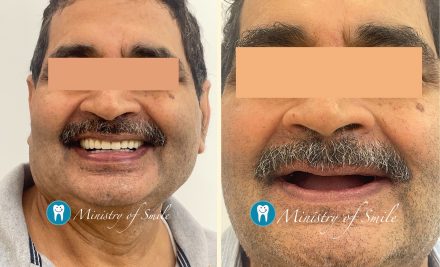 The Best Dental Implant Clinic Near Me in Gurgaon