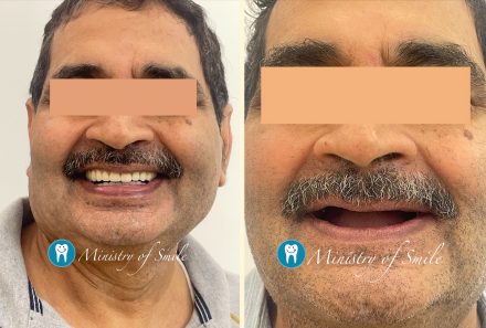 The Best Dental Implant Clinic Near Me in Gurgaon