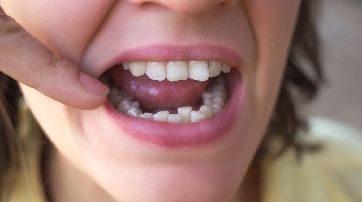 How Can I Fix Crooked Teeth Without Braces?