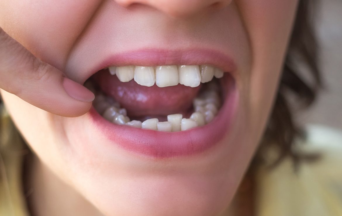 How Can I Fix Crooked Teeth Without Braces?