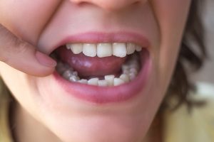How Can I Fix Crooked Teeth Without Braces?