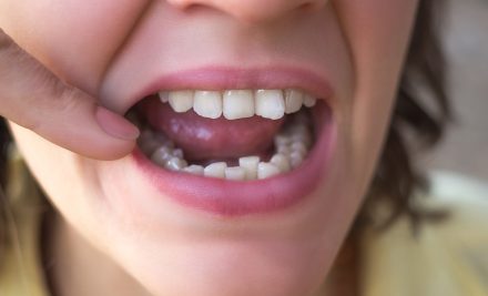 How Can I Fix Crooked Teeth Without Braces?