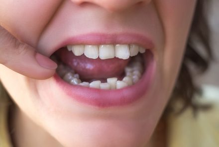 How Can I Fix Crooked Teeth Without Braces?