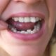 How Can I Fix Crooked Teeth Without Braces?