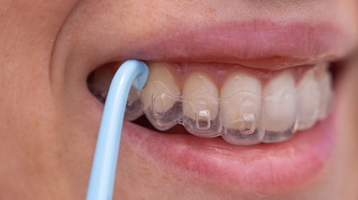 How Long Does Invisalign Treatment Take?