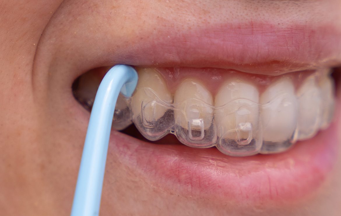 How Long Does Invisalign Treatment Take?