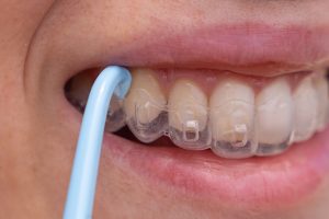 How Long Does Invisalign Treatment Take?