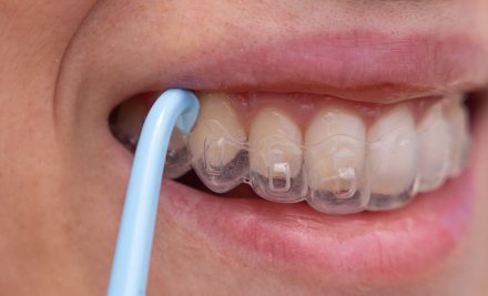 How Long Does Invisalign Treatment Take?