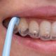 How Long Does Invisalign Treatment Take?