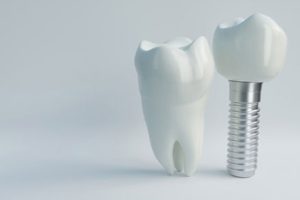 5 Signs You Need a Dental Implant Instead of a Dental Crown