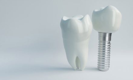 5 Signs You Need a Dental Implant Instead of a Dental Crown