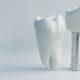 5 Signs You Need a Dental Implant Instead of a Dental Crown