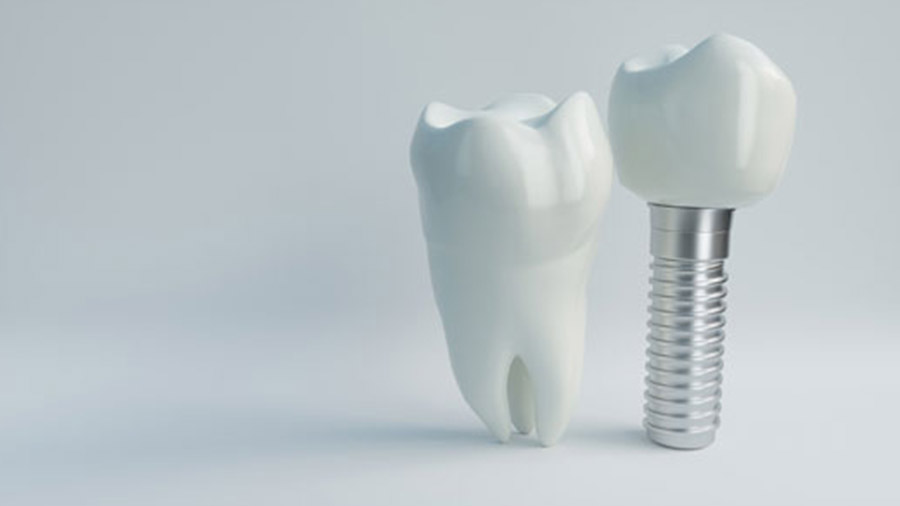 5 Signs You Need a Dental Implant Instead of a Dental Crown