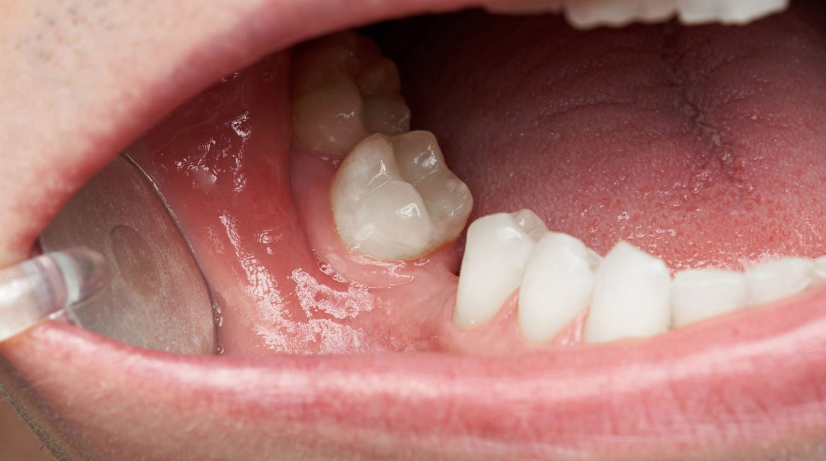 Can Missing Teeth Cause Jawbone Loss?