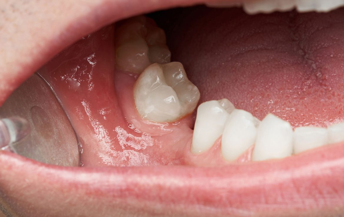 Can Missing Teeth Cause Jawbone Loss?