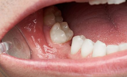 Can Missing Teeth Cause Jawbone Loss?
