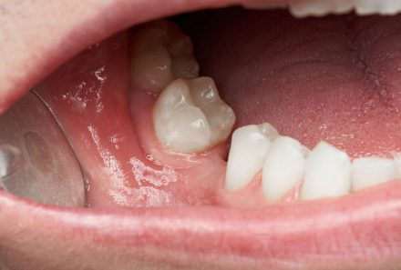 Can Missing Teeth Cause Jawbone Loss?