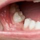 Can Missing Teeth Cause Jawbone Loss?