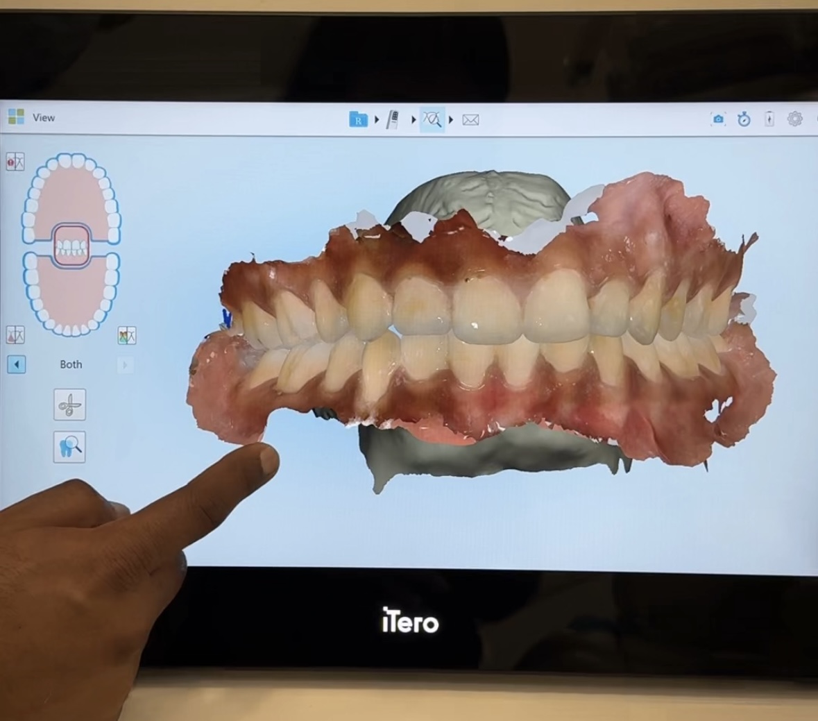 invisalign treatment stage 3
