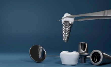Same Day Dental Implants in Gurgaon