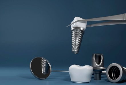 Same Day Dental Implants in Gurgaon