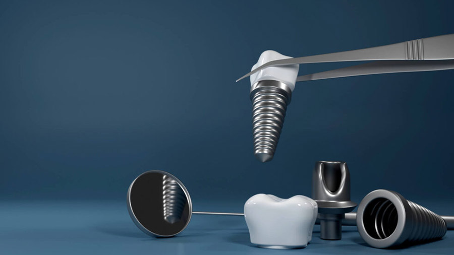 Same Day Dental Implants in Gurgaon