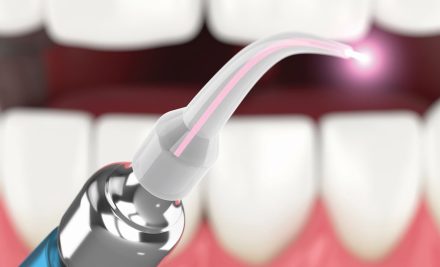 Laser Teeth Desensitisation in Gurgaon