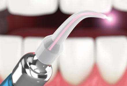 Laser Teeth Desensitisation in Gurgaon
