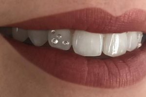 Tooth Jewellery in Gurgaon
