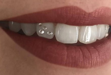 Tooth Jewellery in Gurgaon