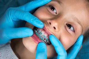 Best Age to Get Braces in Gurgaon