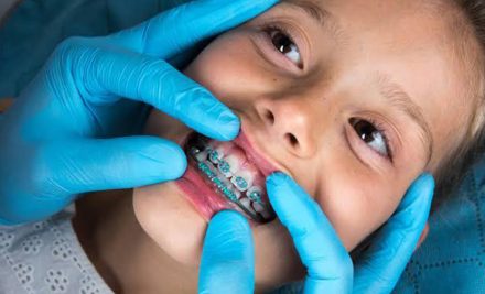 Best Age to Get Braces in Gurgaon