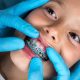 Best Age to Get Braces in Gurgaon