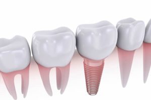 Best Questions to Ask a Dental Implantologist Before Implant Treatment