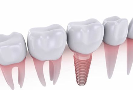 Best Questions to Ask a Dental Implantologist Before Implant Treatment