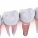Best Questions to Ask a Dental Implantologist Before Implant Treatment